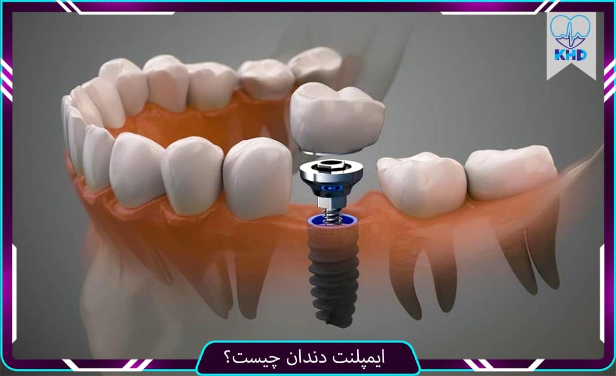 ایمپلنت دندان چیست؟