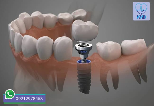 ویژگی ایمپلنت دندان