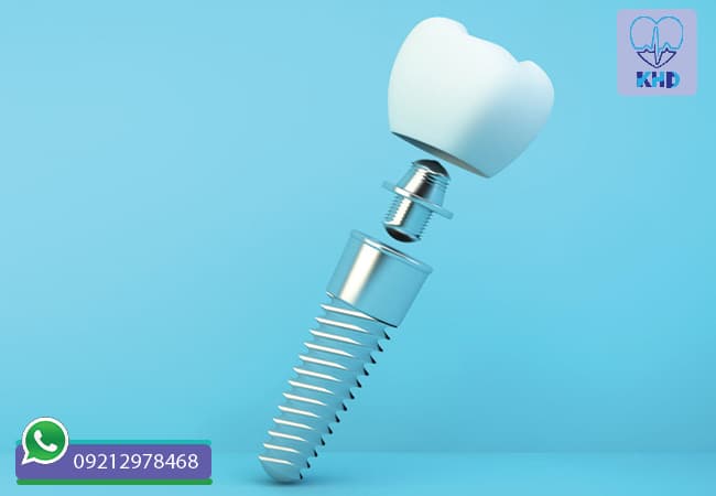 ایمپلنت دندان